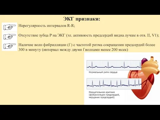 Нерегулярность интервалов R-R; Отсутствие зубца Р на ЭКГ (эл. активность