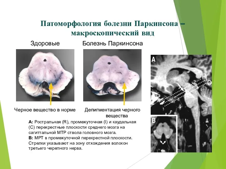 Патоморфология болезни Паркинсона – макроскопический вид