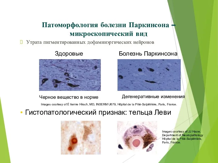 Патоморфология болезни Паркинсона – микроскопический вид Утрата пигментированных дофаминэргических нейронов Черное вещество в