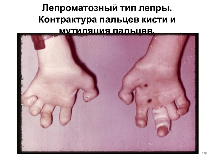 Лепроматозный тип лепры. Контрактура пальцев кисти и мутиляция пальцев.