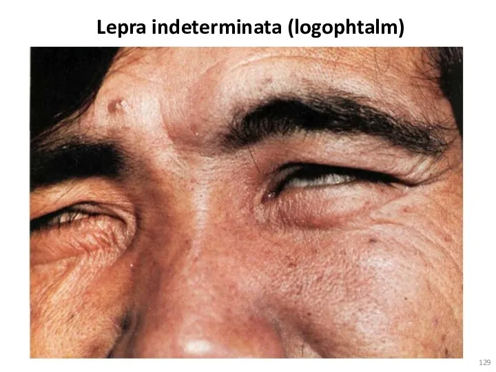 Lepra indeterminata (logophtalm)