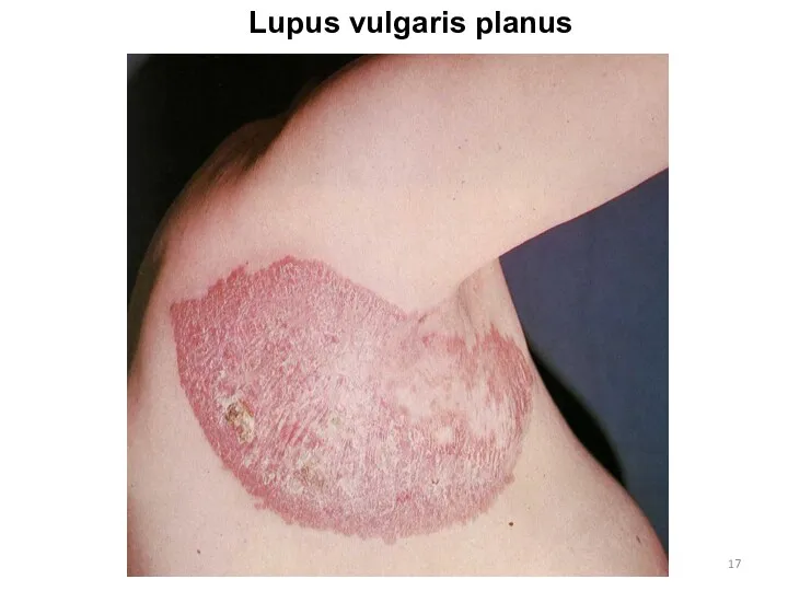 Lupus vulgaris planus