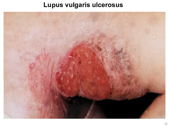 Lupus vulgaris ulcerosus