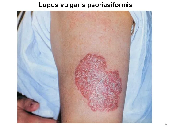 Lupus vulgaris psoriasiformis