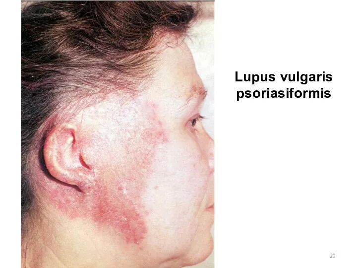 Lupus vulgaris psoriasiformis