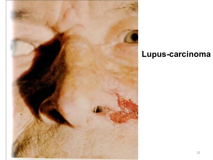 Lupus-carcinoma