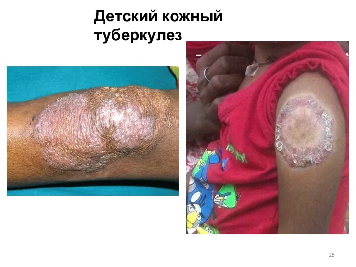 Детский кожный туберкулез