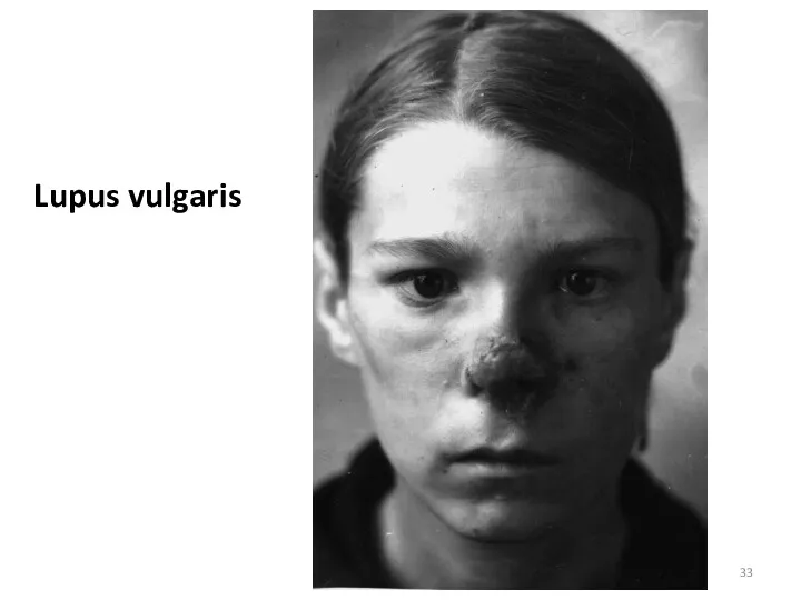 Lupus vulgaris