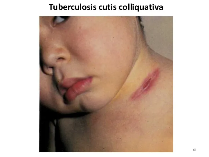 Tuberculosis cutis colliquativa