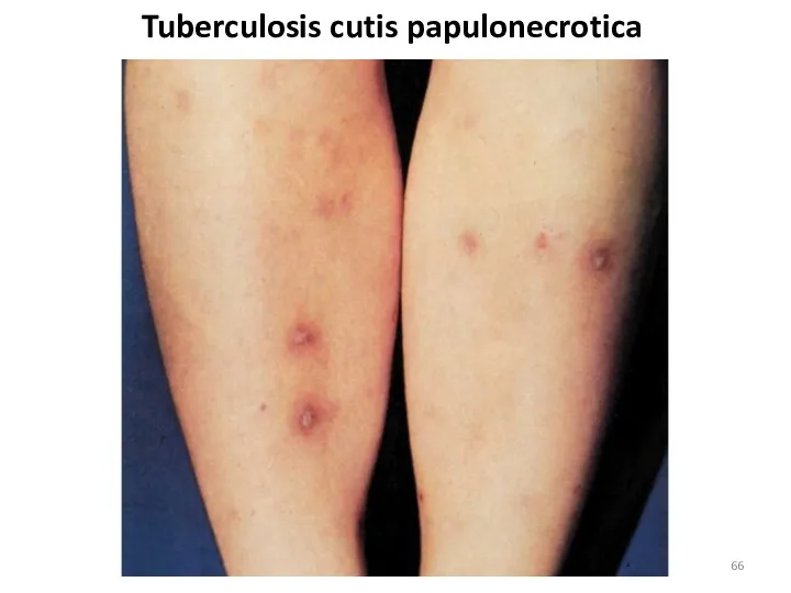 Tuberculosis cutis papulonecrotica