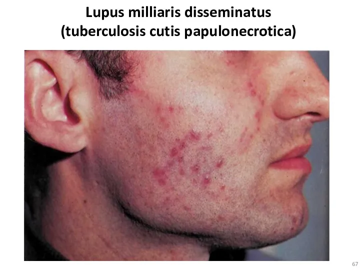 Lupus milliaris disseminatus (tuberculosis cutis papulonecrotica)