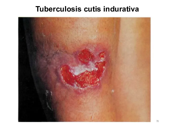 Tuberculosis cutis indurativa