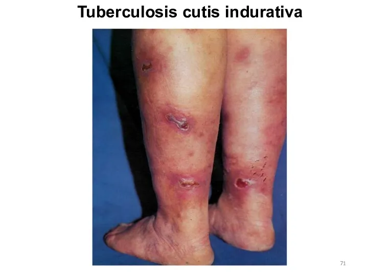 Tuberculosis cutis indurativa