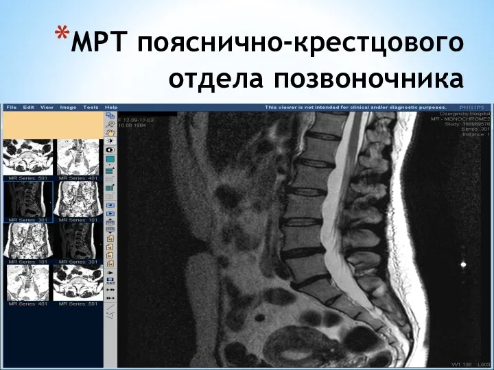 МРТ пояснично-крестцового отдела позвоночника