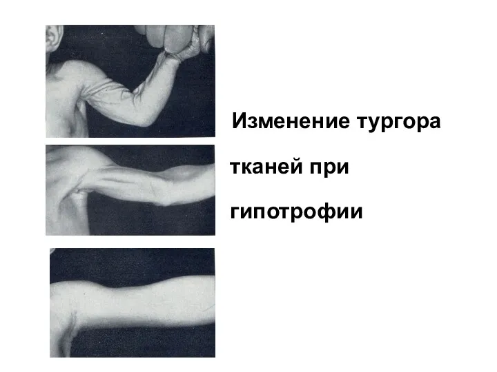 Изменение тургора тканей при гипотрофии