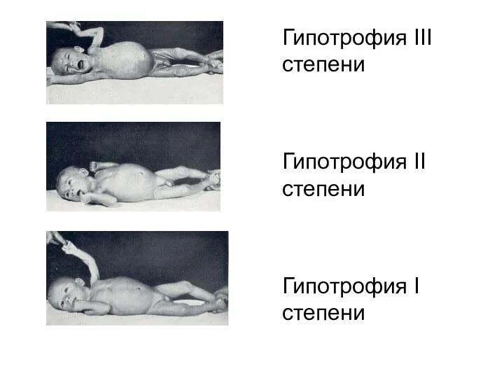 Гипотрофия III степени Гипотрофия II степени Гипотрофия I степени