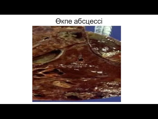 Өкпе абсцессі