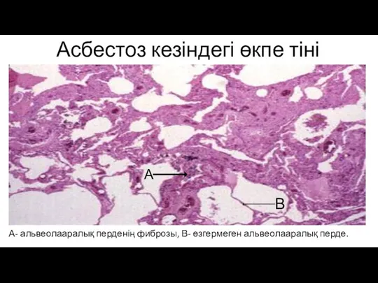 Асбестоз кезіндегі өкпе тіні А- альвеолааралық перденің фиброзы, В- өзгермеген альвеолааралық перде. А В