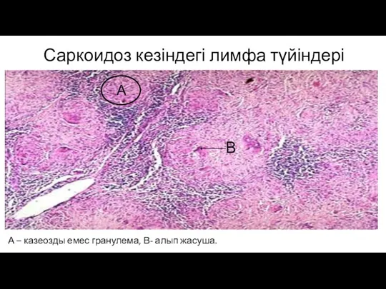 Саркоидоз кезіндегі лимфа түйіндері А – казеозды емес гранулема, В- алып жасуша. А В