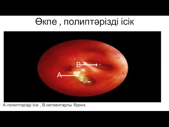 Өкпе , полиптәрізді ісік А-полиптәрізді ісік , В-сегментарлы бронх. А В