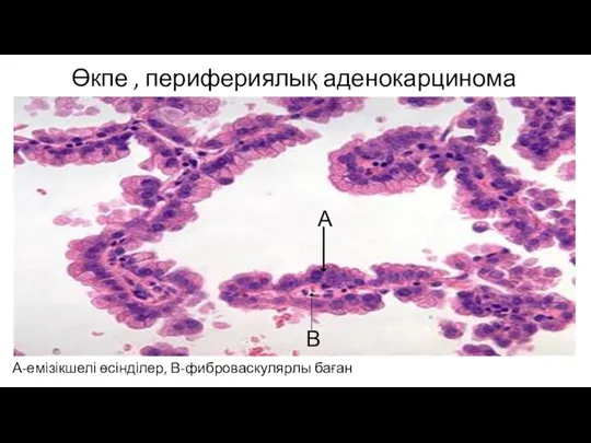 Өкпе , перифериялық аденокарцинома А-емізікшелі өсінділер, В-фиброваскулярлы баған А В