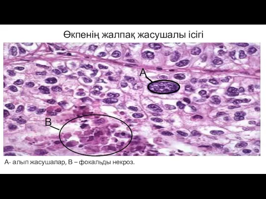 Өкпенің жалпақ жасушалы ісігі А- алып жасушалар, В – фокальды некроз. А В