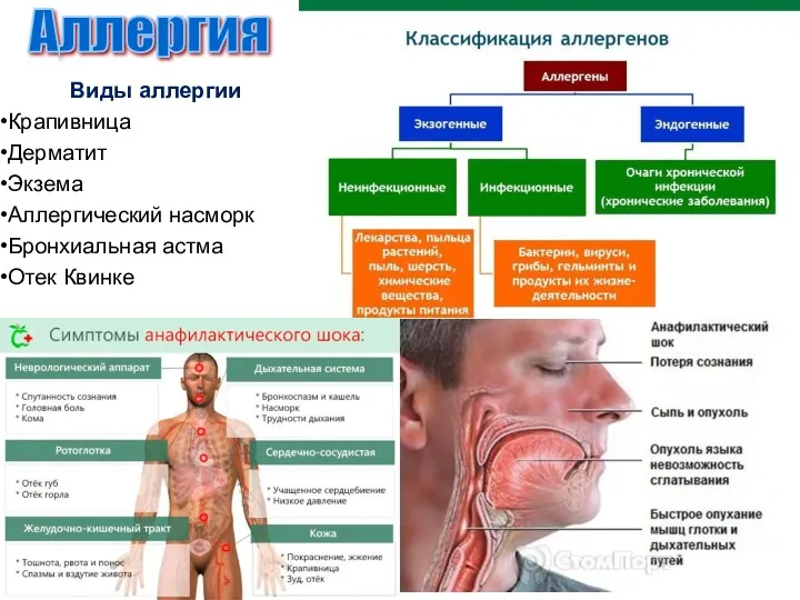 Виды аллергии Крапивница Дерматит Экзема Аллергический насморк Бронхиальная астма Отек Квинке Аллергия