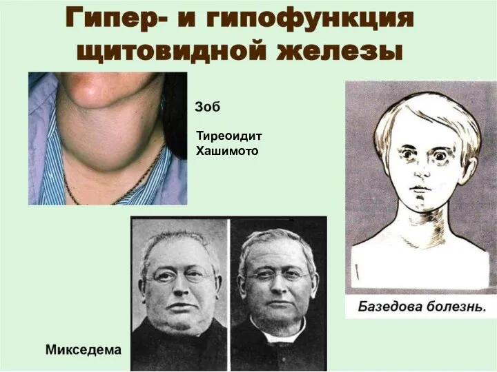 Тиреоидит Хашимото