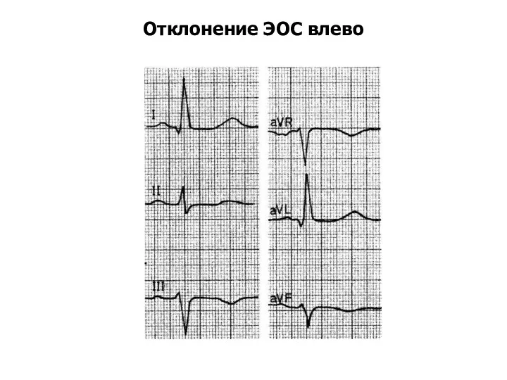 Отклонение ЭОС влево