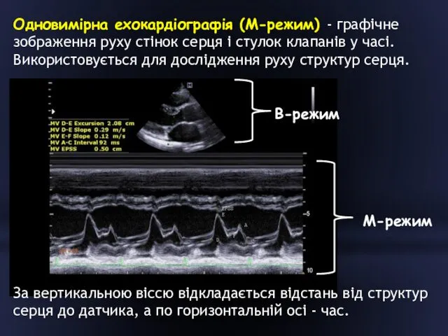 Одновимірна ехокардіографія (М-режим) - графічне зображення руху стінок серця і