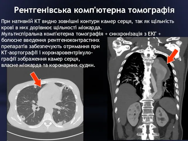 Рентгенівська комп'ютерна томографія При нативній KT видно зовнішні контури камер