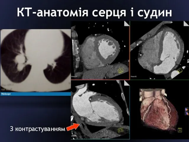 КТ-анатомія серця і судин З контрастуванням