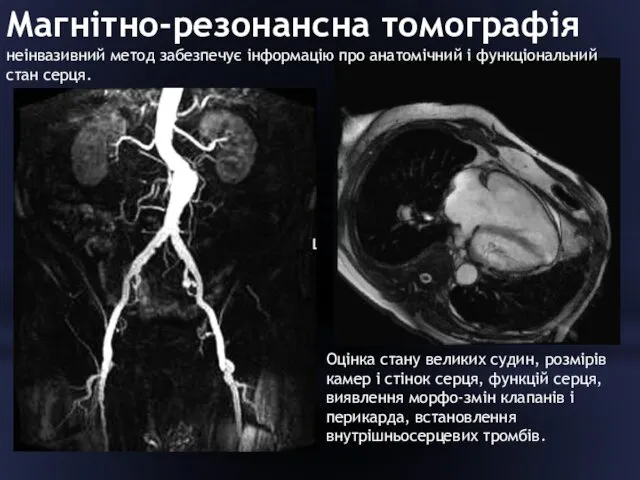 Магнітно-резонансна томографія неінвазивний метод забезпечує інформацію про анатомічний і функціональний