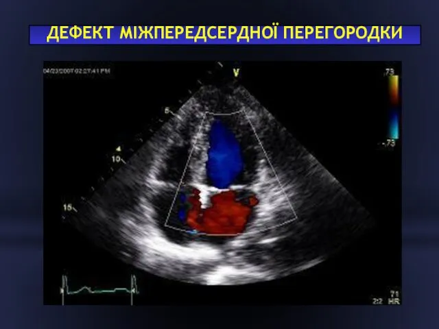 ДЕФЕКТ МІЖПЕРЕДСЕРДНОЇ ПЕРЕГОРОДКИ