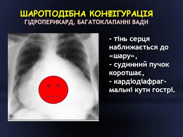 ШАРОПОДІБНА КОНФІГУРАЦІЯ ГІДРОПЕРИКАРД, БАГАТОКЛАПАННІ ВАДИ - тінь серця наближається до