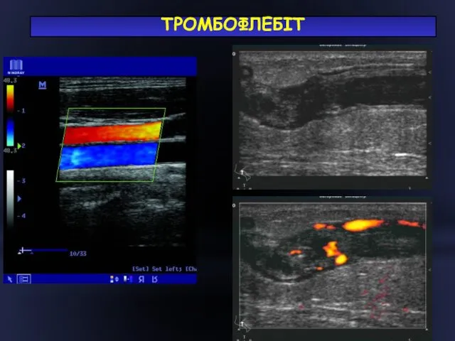 ТРОМБОФЛЕБІТ