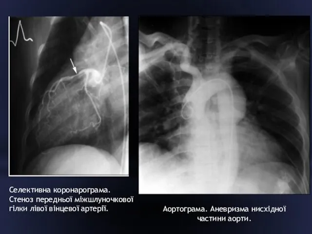 Аортограма. Аневризма нисхідної частини аорти. Селективна коронарограма. Стеноз передньої міжшлуночкової гілки лівої вінцевої артерії.