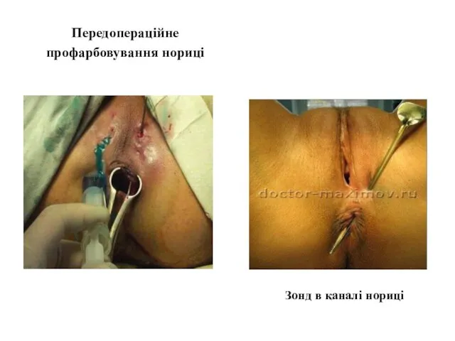 Передопераційне профарбовування нориці Зонд в каналі нориці