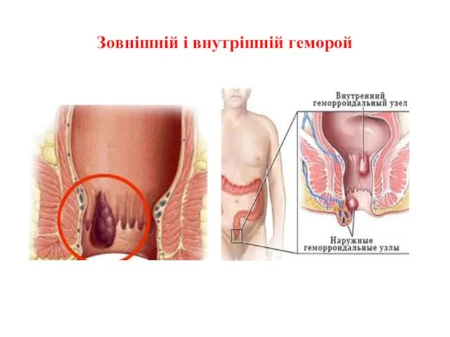 Зовнішній і внутрішній геморой