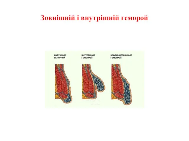 Зовнішній і внутрішній геморой