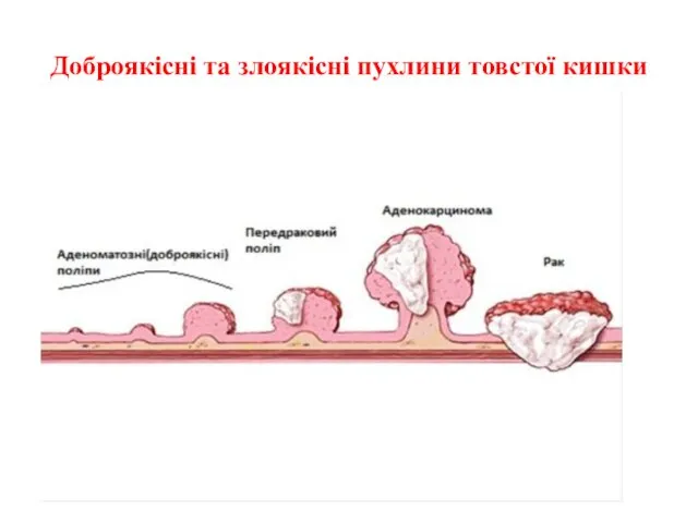 Доброякісні та злоякісні пухлини товстої кишки