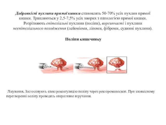 Доброякісні пухлини прямої кишки становлять 50-70% усіх пухлин прямої кишки.