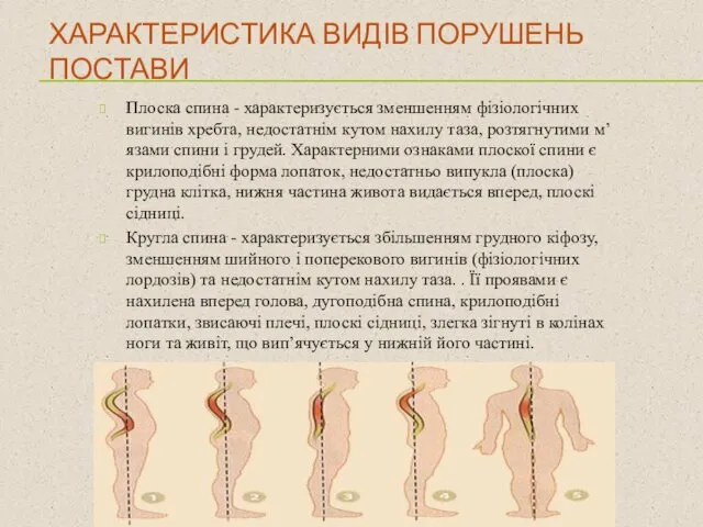 ХАРАКТЕРИСТИКА ВИДІВ ПОРУШЕНЬ ПОСТАВИ Плоска спина - характеризується зменшенням фізіологічних