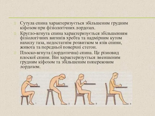 Сутула спина характеризується збільшеним грудним кіфозом при фізіологічних лордозах. Кругло-вгнута