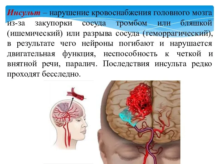 Инсульт – нарушение кровоснабжения головного мозга из-за закупорки сосуда тромбом