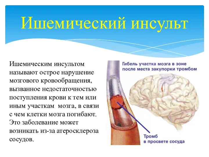 Ишемический инсульт Ишемическим инсультом называют острое нарушение мозгового кровообращения, вызванное