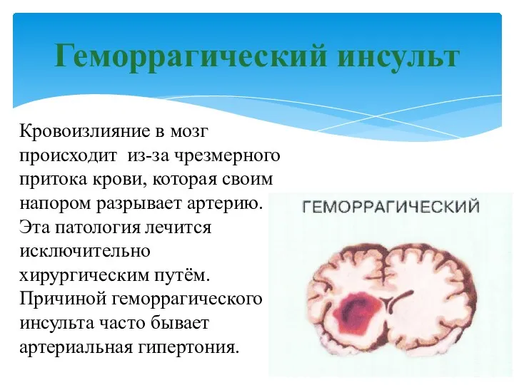 Геморрагический инсульт Кровоизлияние в мозг происходит из-за чрезмерного притока крови,