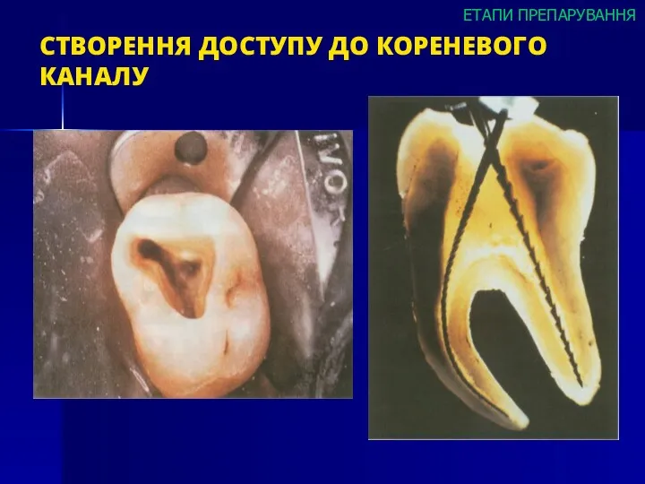 СТВОРЕННЯ ДОСТУПУ ДО КОРЕНЕВОГО КАНАЛУ ЕТАПИ ПРЕПАРУВАННЯ