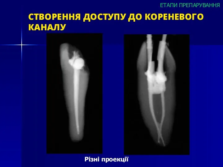 СТВОРЕННЯ ДОСТУПУ ДО КОРЕНЕВОГО КАНАЛУ Різні проекції ЕТАПИ ПРЕПАРУВАННЯ