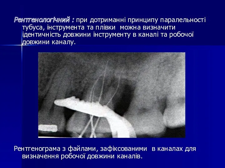 Рентгенологічний : при дотриманні принципу паралельності тубуса, інструмента та плівки
